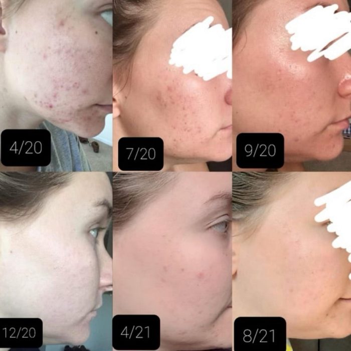 ژل ضد جوش و لایه بردار دیفرین Differin Adapalene Gel 0.1% Retinoid Acne Treatment - Image 2