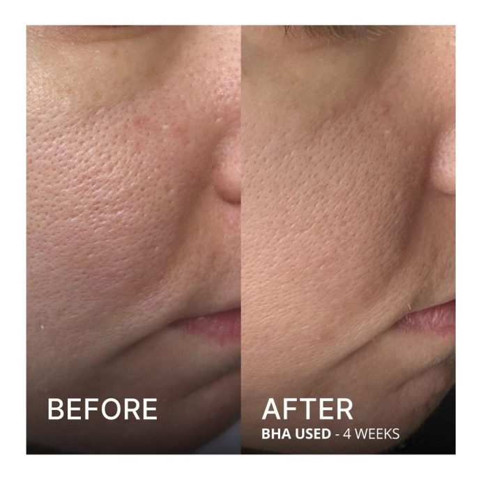 تونر پوست چرب و جوشدار پائولا چویس PAULA'S LE CHOICE XFOL IAT SKIN PERFECTING 2% BHA Liquid Exfoliant SALICYLIC ACID All Skin Types UNCLOGS & SHRINKS ENLARGED PORES SMOOTHS &EVENS SKIN TONE LIGHTWEIGHT LIQUID ABSORBS QUICKLY 118 ml - Image 4
