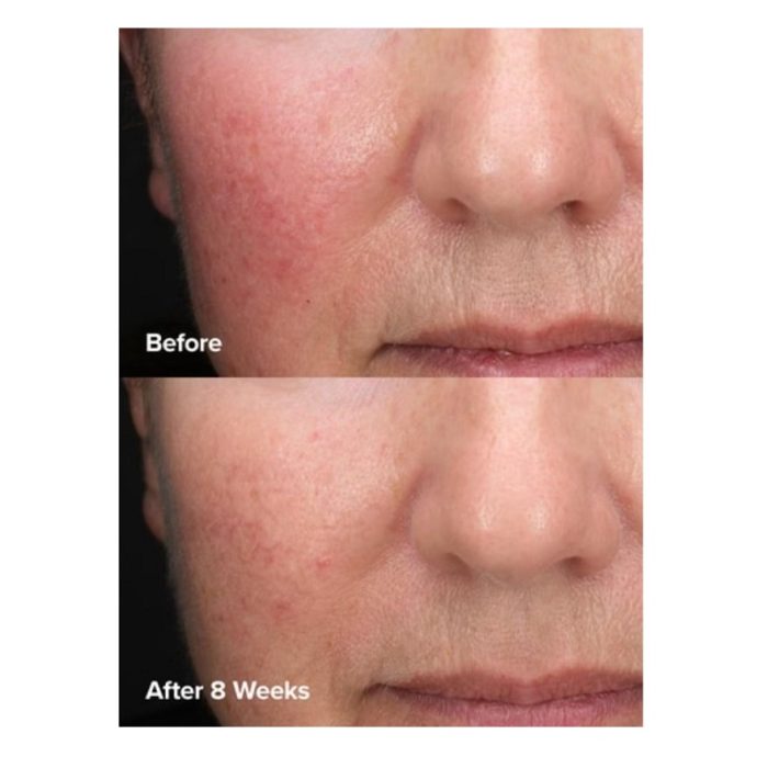 تونر پوست چرب و جوشدار پائولا چویس PAULA'S LE CHOICE XFOL IAT SKIN PERFECTING 2% BHA Liquid Exfoliant SALICYLIC ACID All Skin Types UNCLOGS & SHRINKS ENLARGED PORES SMOOTHS &EVENS SKIN TONE LIGHTWEIGHT LIQUID ABSORBS QUICKLY 118 ml - Image 6