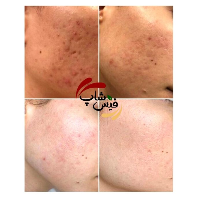 کرم ضد لک دپی وایت ای سی ام ACM - Image 3