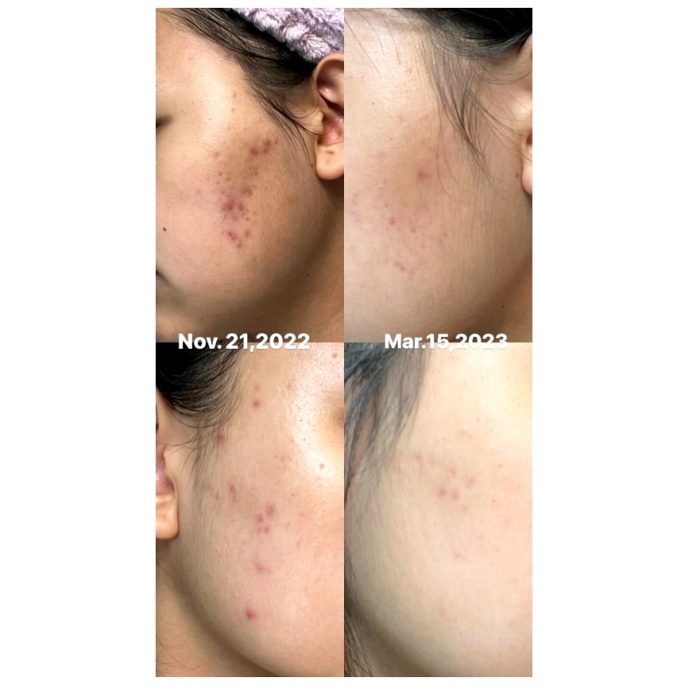سرم ضدجوش و ضدلک تریتمنت اسپات اکسیس وای - Image 3